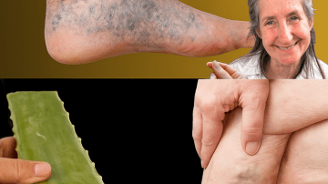 I Almost Lost My Kidneys – Until This 3-Ingredient Elixir Saved Me